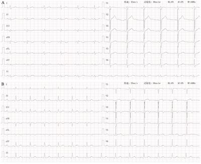 Relationship Between Serum Concentration of Adrenomedullin and Myocardial Ischemic T Wave Changes in Patients With Lung Cancer